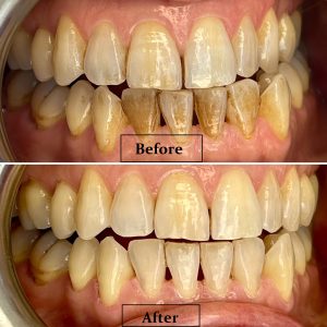 Airpolish before after 1