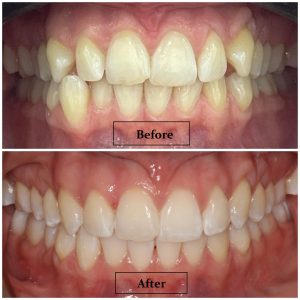 Invisalign 2