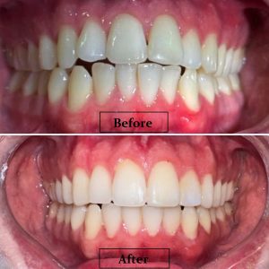 Invisalign before after 1