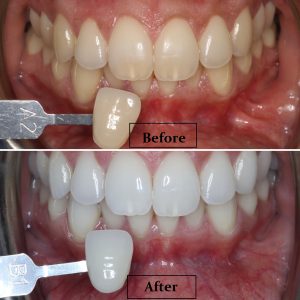 teeth Whitening before after 1