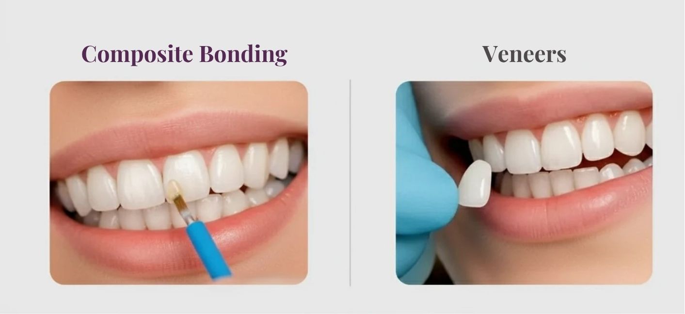 Composite bonding vs veneer in bristol