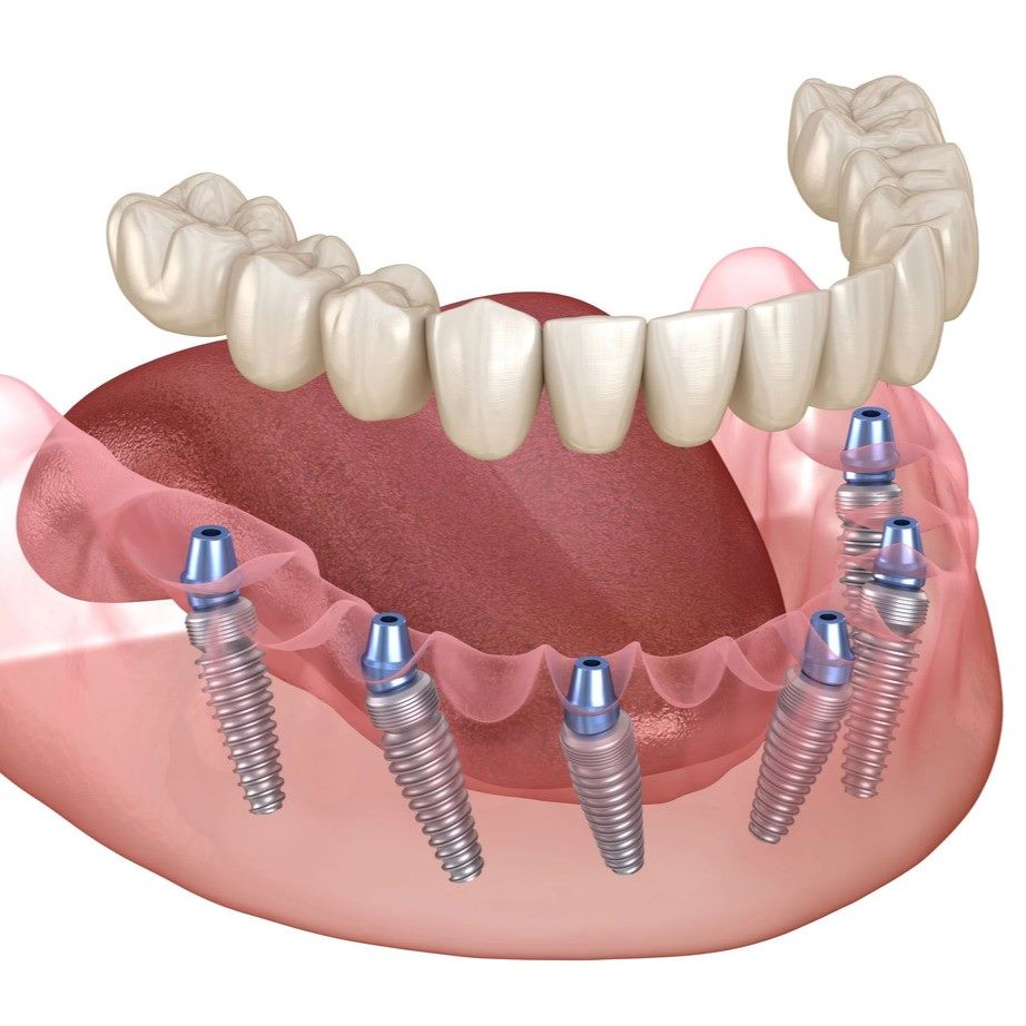 Full Mouth All-on-4Dental Implants