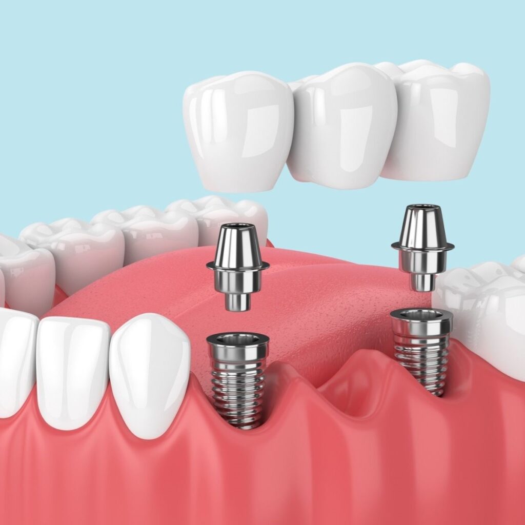 photo of implant bridge