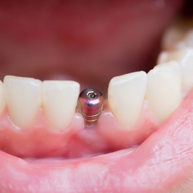 single Tooth Dental Implant