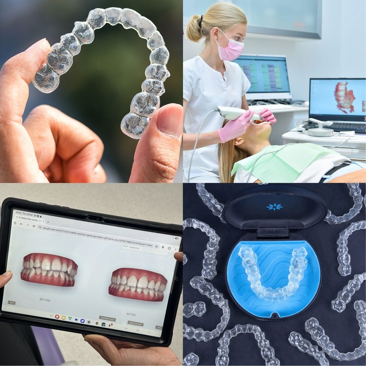 what is invisalign. system, process, plan, mechanism