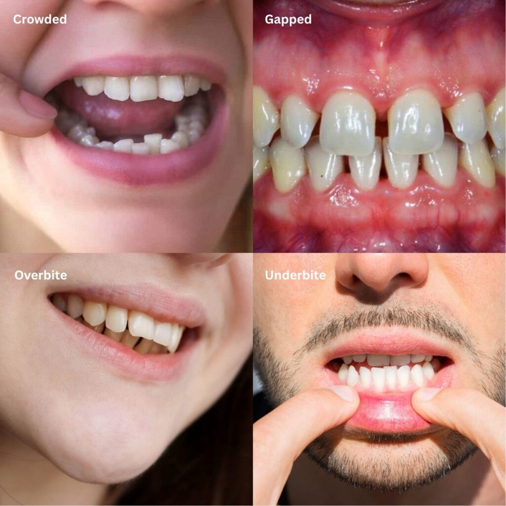 what is invisalign suited for. moderate crowding, gapped teeth, overbite, underbite