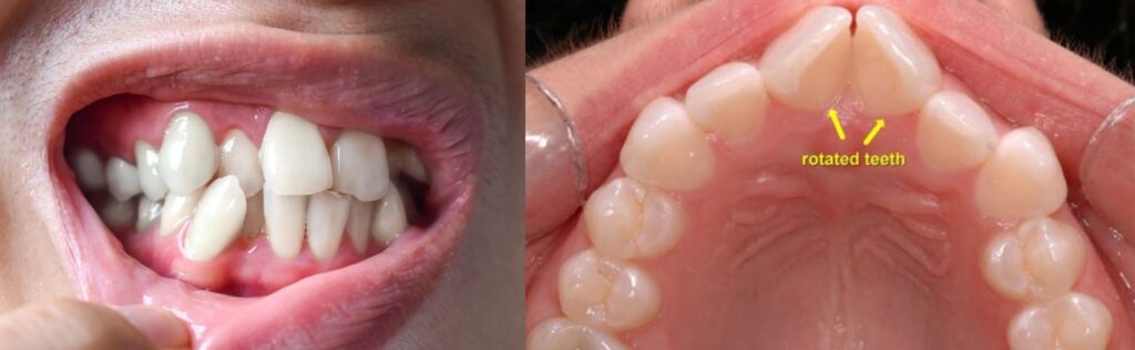 what situations invisalign fails at. severe misalignment and rotations,...