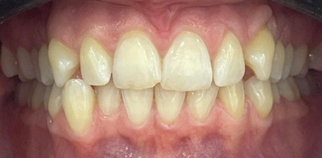 Before treatment image