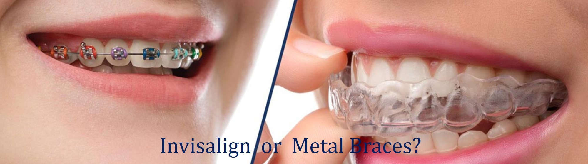 invisalign vs metal braces invisalign or metal braces for teeth straightening