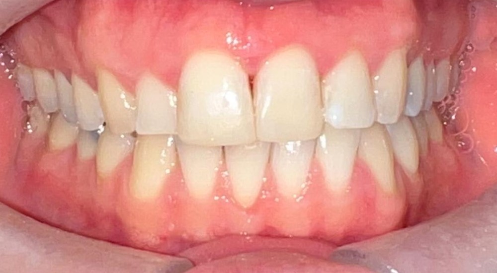 Restored upper front tooth after composite bonding