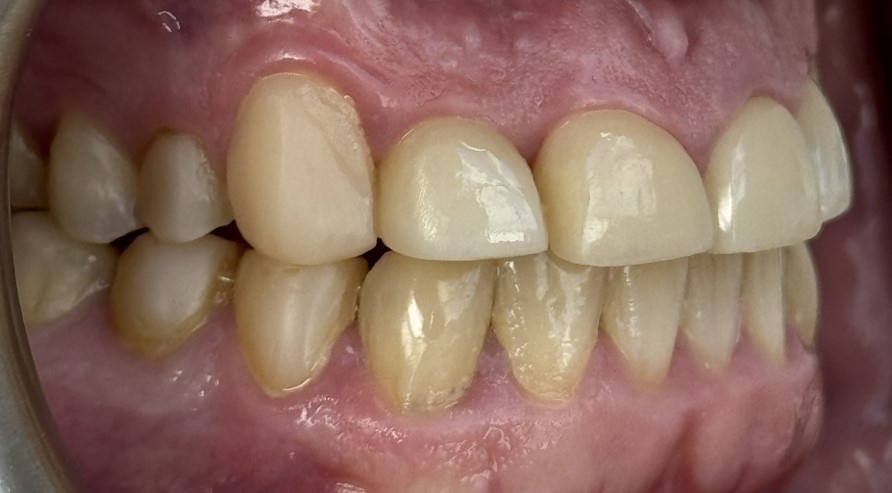 Upper front teeth restored with composite bonding