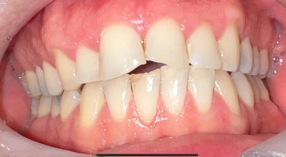 Chipped upper front tooth before composite bonding
