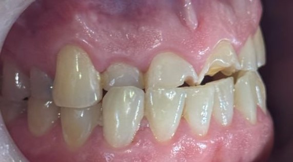 Worn and fractured upper front teeth before composite bonding