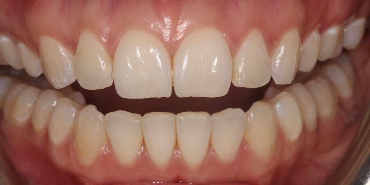 After Invisalign clear aligner treatment showing straighter teeth at Lodge Causeway Dental Centre Bristol