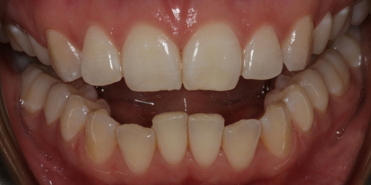 Before Invisalign treatment showing crowded teeth at Lodge Causeway Dental Centre Bristol