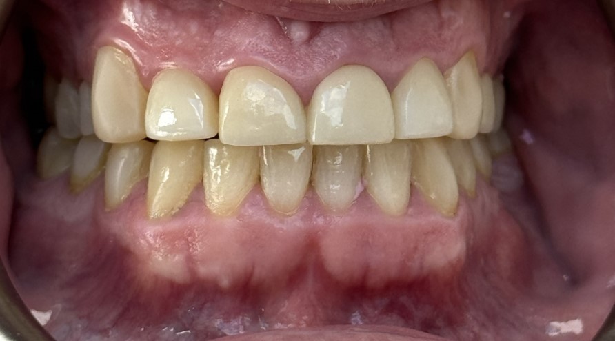 After composite bonding treatment showing a refined natural-looking smile in Bristol