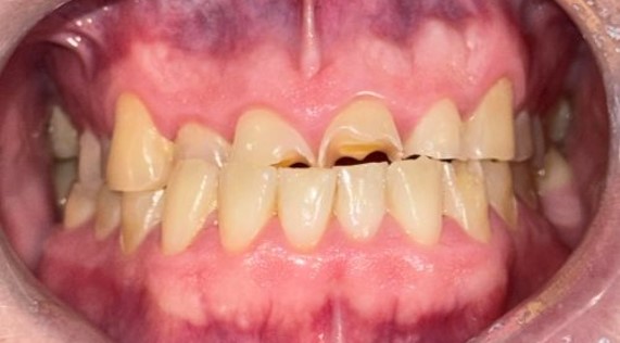 Before composite bonding treatment at Lodge Causeway Dental Centre in Bristol