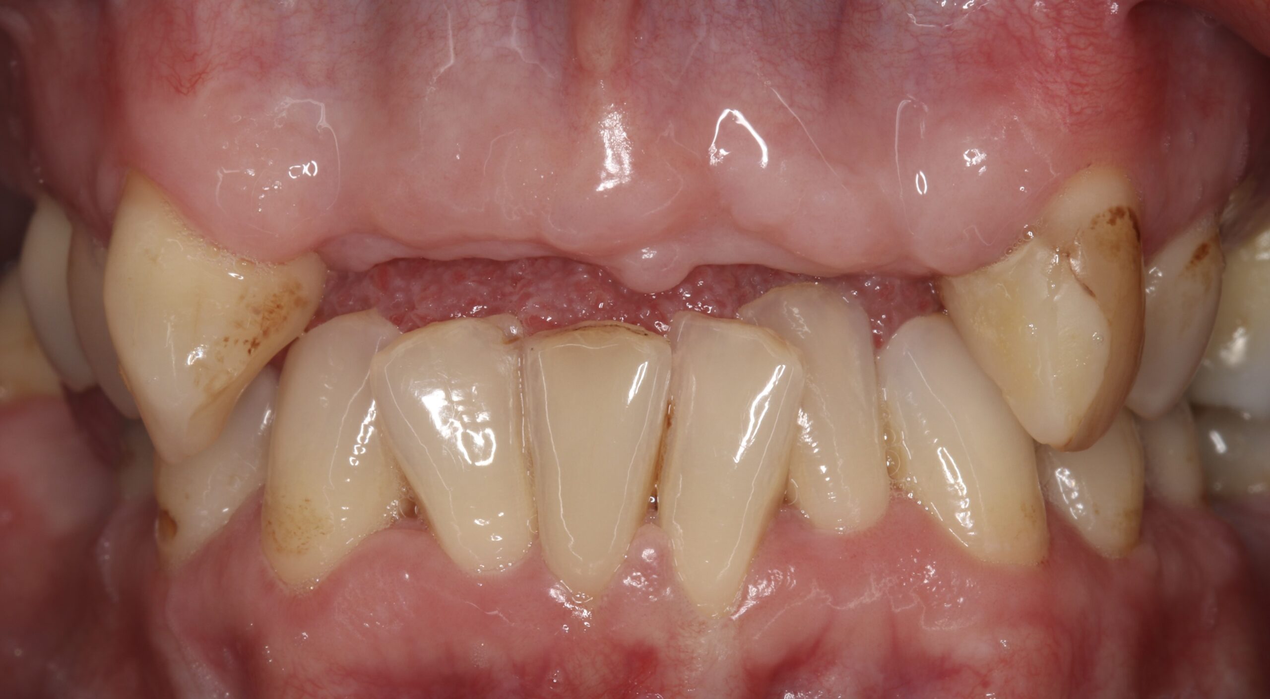 Before dental implant treatment showing missing upper front teeth