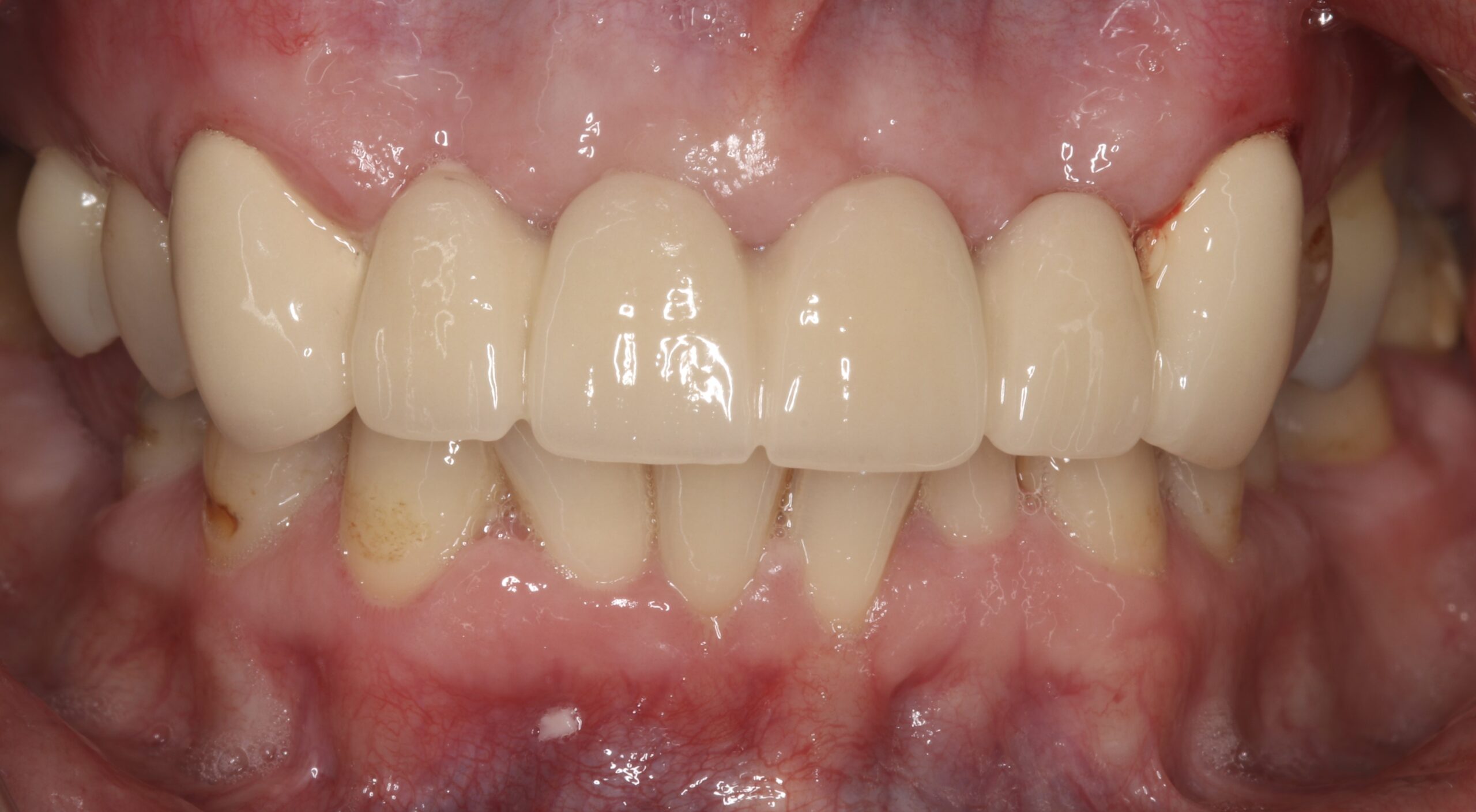After dental implant treatment showing restoration of the upper front teeth