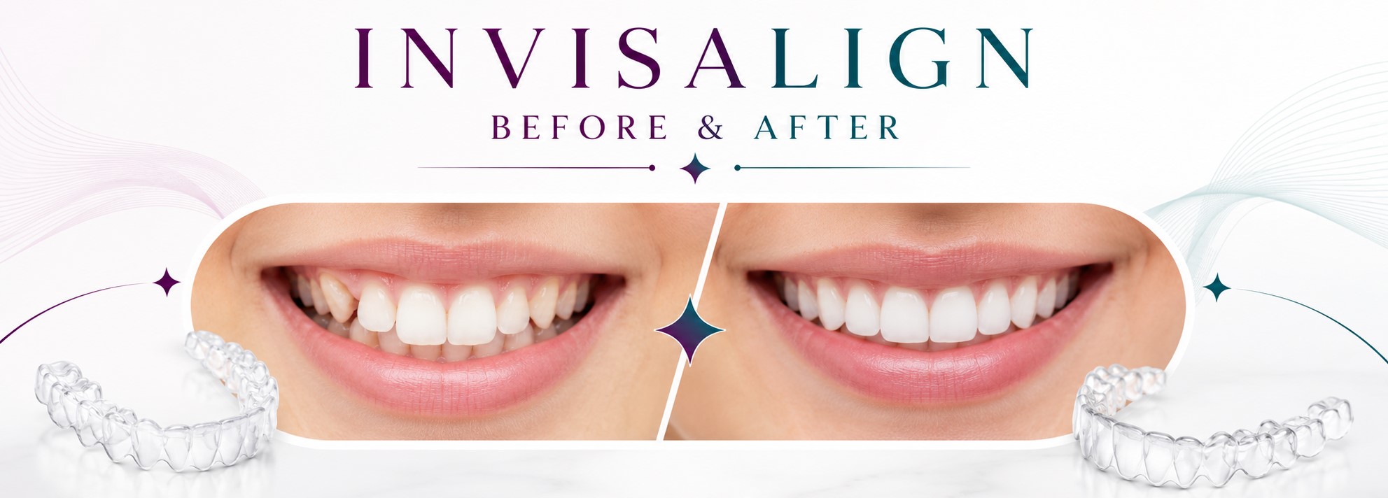 invisalign before and after images
