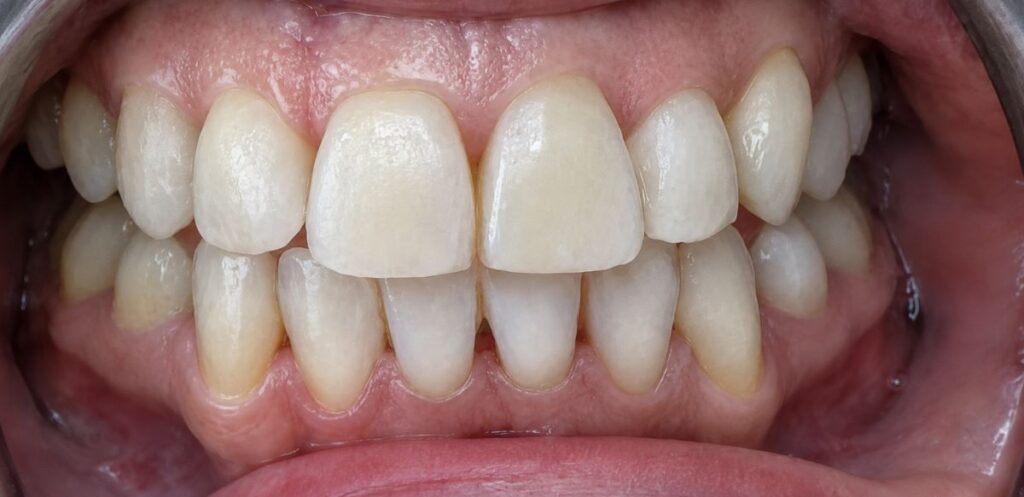 After: Substantial improvement in upper and lower alignment, with the canines positioned more harmoniously within the arches and a noticeably more even smile.