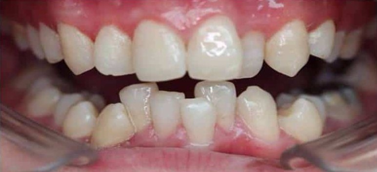 Before