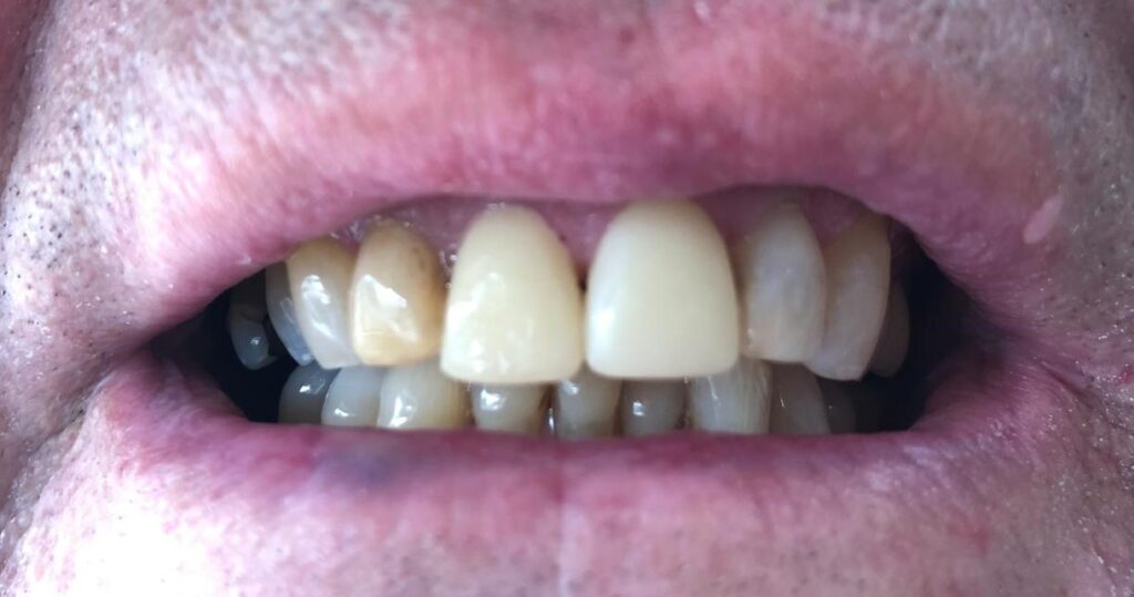 Reshaped upper lateral teeth after composite bonding