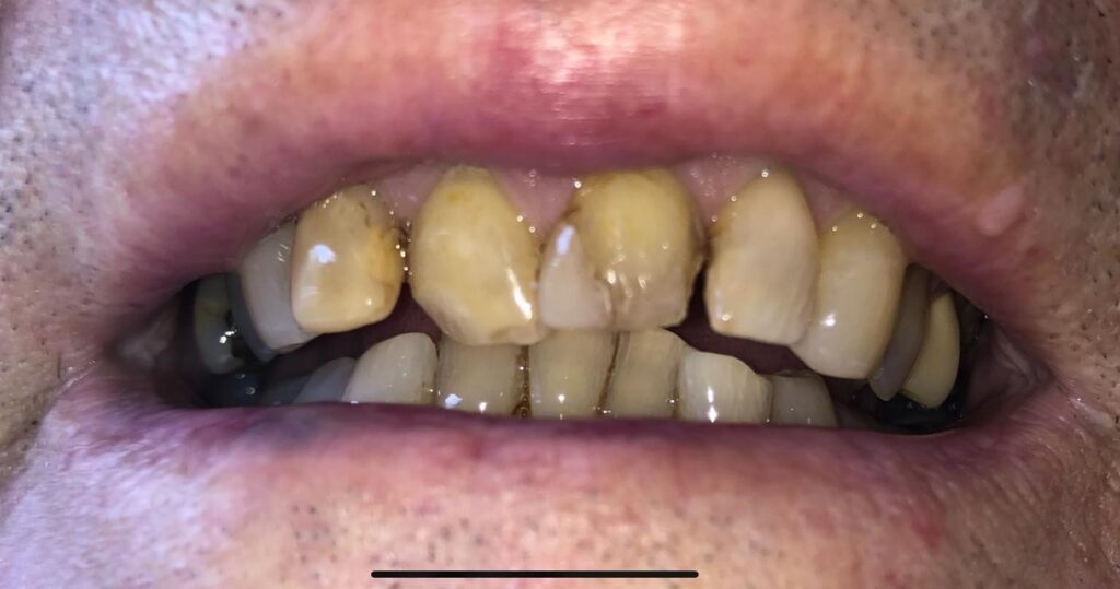 Uneven upper lateral teeth before composite bonding