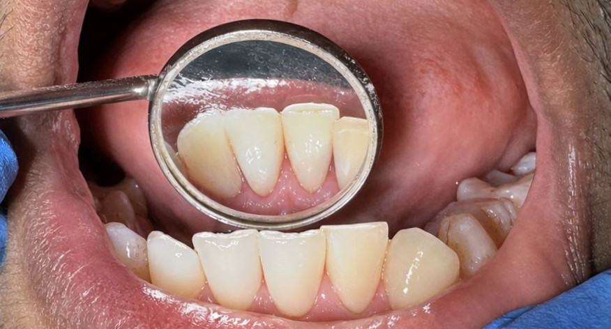 After: Airpolish treatment. After professional air polishing and cleaning, staining and surface deposits were significantly reduced, leaving the lower front teeth visibly cleaner, brighter and healthier-looking.