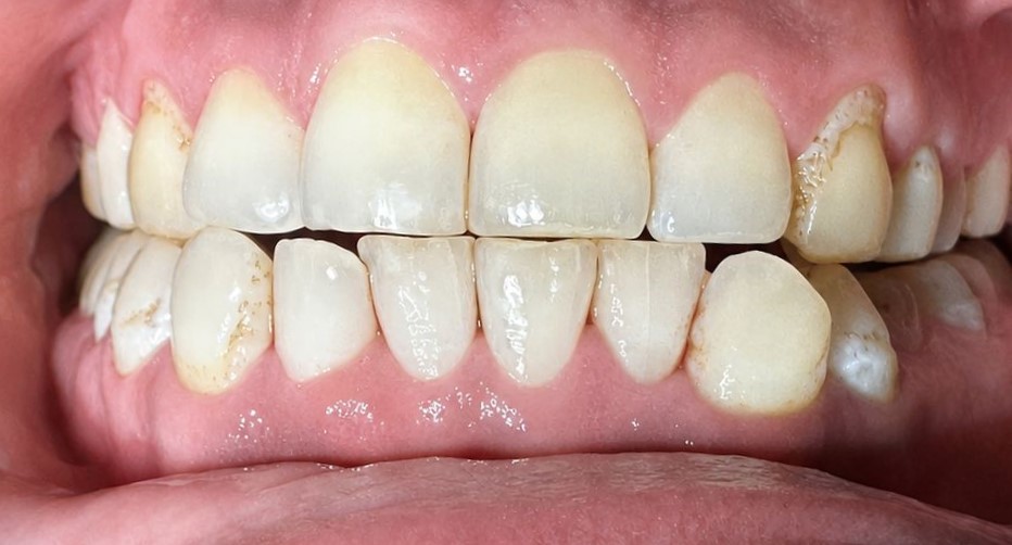 After Air Polish treatment showing cleaner and brighter teeth