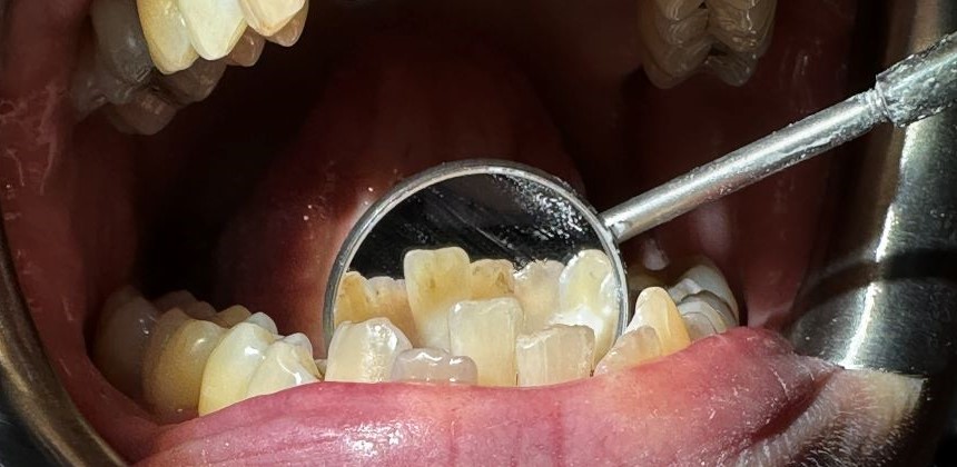 After: Airpolish treatment. Air polishing significantly reduced the visible staining and deposits, leaving the lower front teeth cleaner, brighter and fresher-looking, with improved overall hygiene appearance.