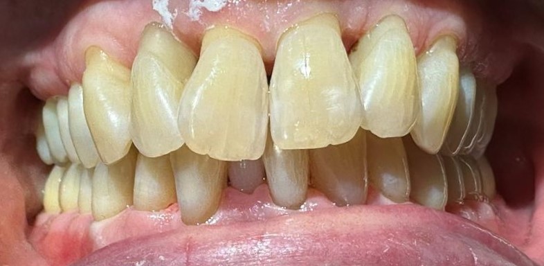 After: Airpolish treatment. Air polishing reduced visible staining and deposits, leaving the teeth noticeably cleaner, brighter and fresher while preserving the natural tooth shape.