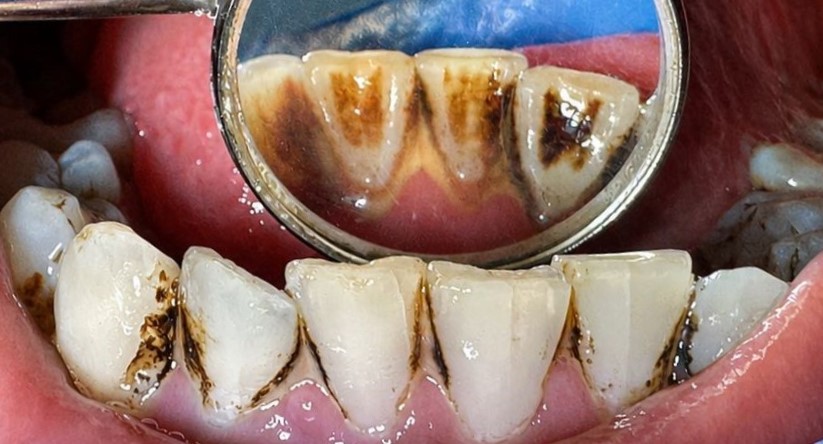 Before: Airpolish treatment. Heavy brown extrinsic staining and plaque/calculus deposits were visible around the lower front teeth and gum margins, affecting cleanliness, appearance and overall oral hygiene.