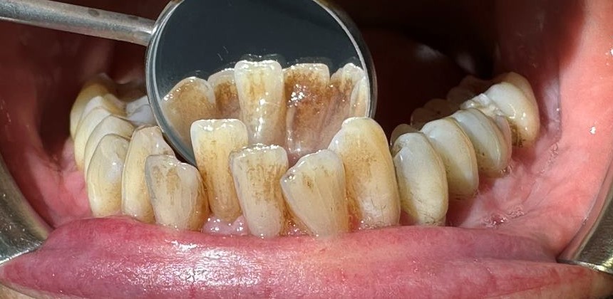 Before: Airpolish treatment. Heavy brown staining and plaque/calculus deposits were visible around the lower front teeth, especially on the inner side between the teeth and along the gumline.
