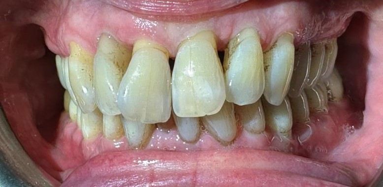Before: Airpolish treatment. Brown surface staining and plaque deposits were visible around the crowded front teeth, especially along the gum margins and between the teeth.