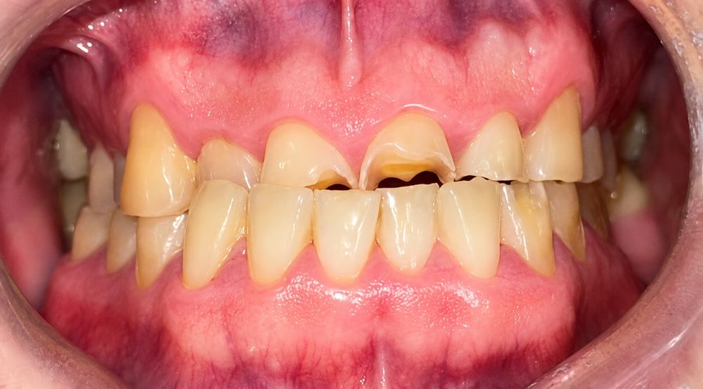 Before composite bonding treatment at Lodge Causeway Dental Centre in Bristol