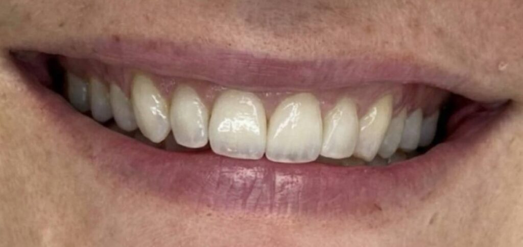 After: Tooth bonding. The smile was refreshed with a cleaner, brighter and more even appearance. The upper front teeth now look smoother, more symmetrical and better balanced, with the defects masked and the smile line improved.