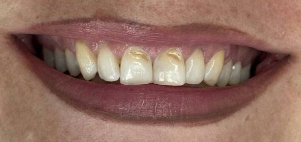Before: Tooth bonding. Visible enamel defects and discolouration on the upper front teeth, especially the central incisors with uneven incisal edges and slight irregularity in the smile line, affecting overall symmetry and appearance.