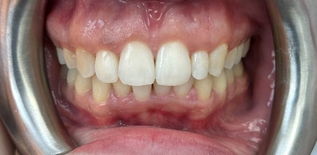 After: Invisalign improved anterior bite closure, bringing the front teeth into a more stable relationship with better overlap, alignment and overall bite coordination.
