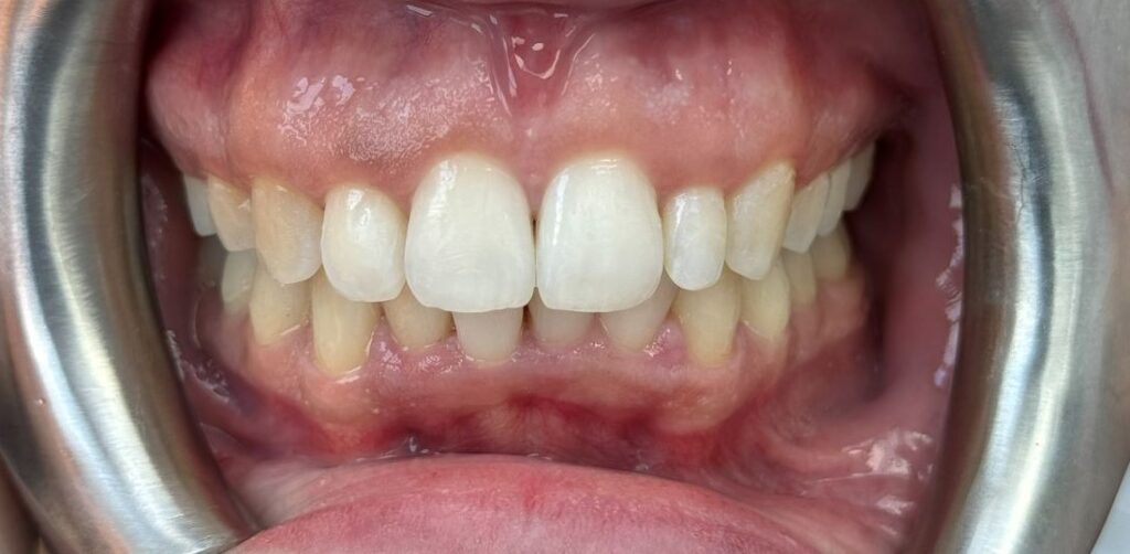 After: Treatment closed the anterior open bite, improved front-tooth alignment and relieved crowding, creating a more even smile and better bite balance.