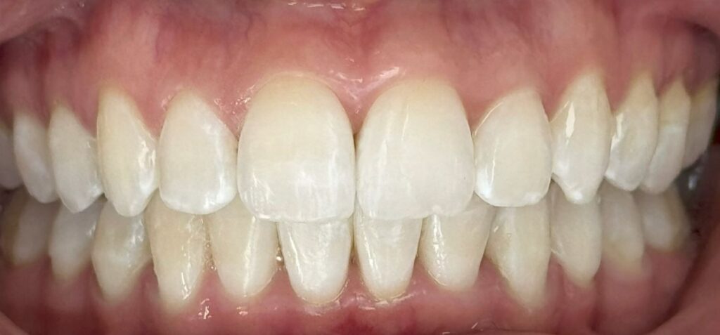 After: Invisalign improved the overall alignment of both arches, reducing crowding and rotations. The upper front teeth now appear straighter and more evenly positioned, with a smoother arch form and a more balanced, coordinated bite.