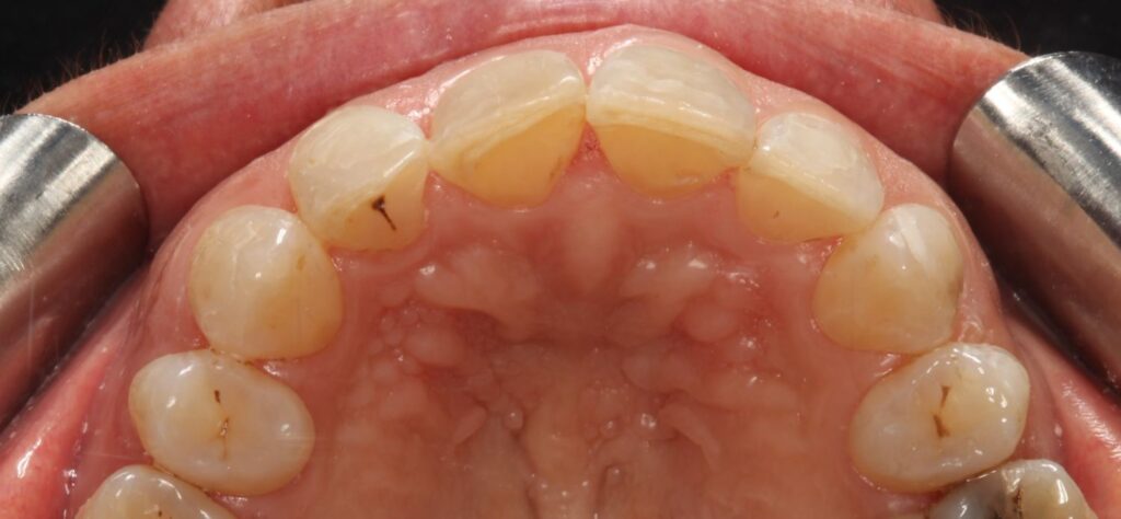 After: Invisalign aligned the upper arch, corrected the rotations, reduced anterior crowding and created a smoother, more even arch form.