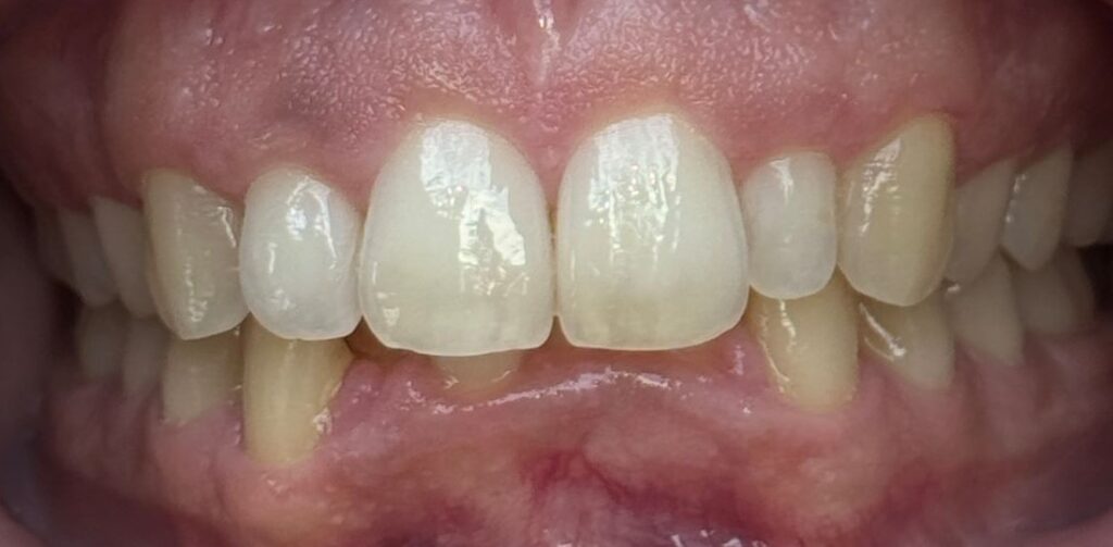 Before: Anterior open bite with reduced contact between the upper and lower front teeth, plus mild irregular anterior alignment affecting bite balance.