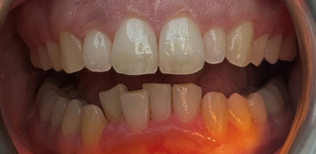 Before: Anterior open bite with lower front crowding and irregular alignment, leaving a visible gap between the upper and lower front teeth