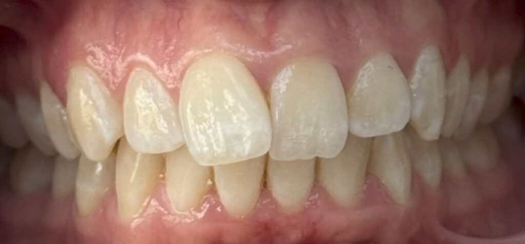 Before: Noticeable crowding and rotations affecting the upper and lower front teeth, with irregular positioning of the upper incisors/laterals and uneven arch alignment. The bite appeared less coordinated, with the front teeth not sitting as evenly together.