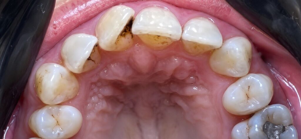 Before: Upper anterior crowding with significant rotations and displacement, especially around the lateral/canine area, creating an irregular arch form and overlapping front teeth.