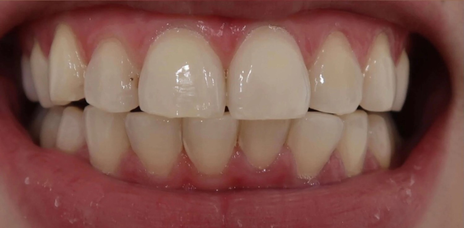 After professional teeth whitening showing a visibly brighter smile