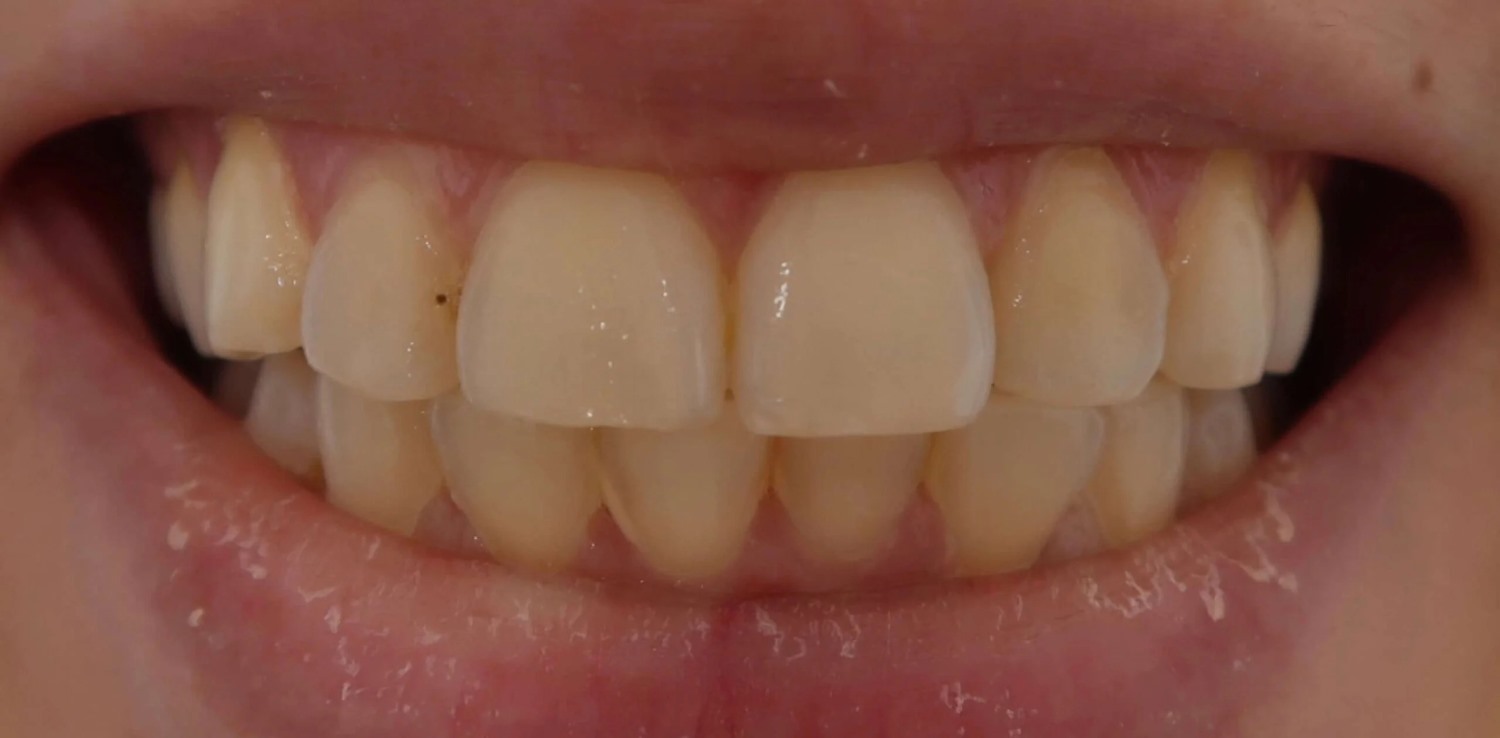 Before professional teeth whitening at Lodge Causeway Dental Centre in Bristol