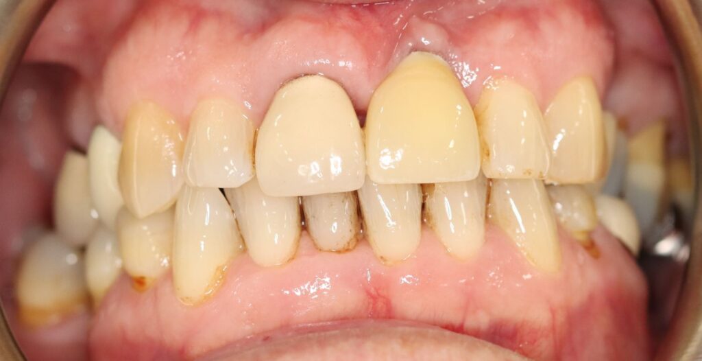 After: Dental implant restoration. ✅Missing tooth restored with a dental implant . ✅Improved continuity and symmetry across the smile . ✅Restored appearance and function in the upper front-tooth area.