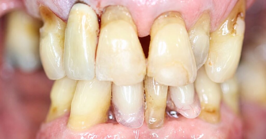 After: Dental implant restoration. ✅Missing tooth restored with an implant-supported crown . ✅Natural tooth shape and contour recreated within the space . ✅Improved continuity and balance across the upper front teeth.
